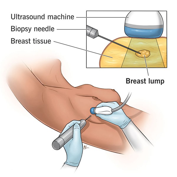 A medical diagram showing the process of performing an ultrasound-guided core needle biopsy on a breast nodule A medical diagram showing the process of performing an ultrasound-guided core needle biopsy on a breast nodule