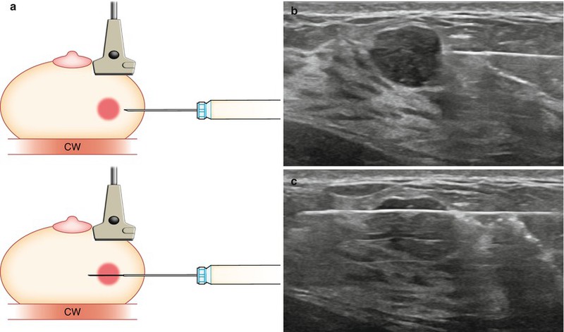 A close-up image showing a biopsy needle being inserted into the breast under ultrasound guidance A close-up image showing a biopsy needle being inserted into the breast under ultrasound guidance