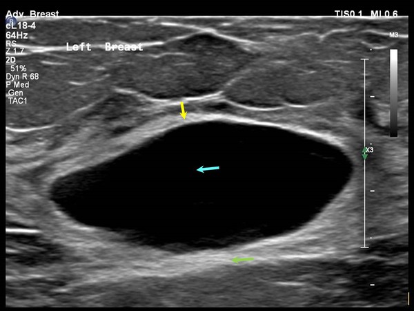 Ultrasound image of a suspicious breast nodule indicating the need for a core needle biopsy Ultrasound image of a suspicious breast nodule indicating the need for a core needle biopsy