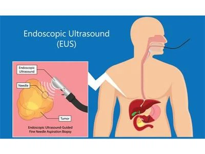 Mis on endoskoopiline ultraheli (EUS)?