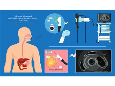 Miks vajate pärast gastroskoopiat EUS -i? Gastroenteroloogi vastused